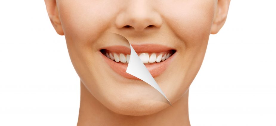 Smile Makeover in Turkey – Full smile transformation with veneers, crowns, and whitening