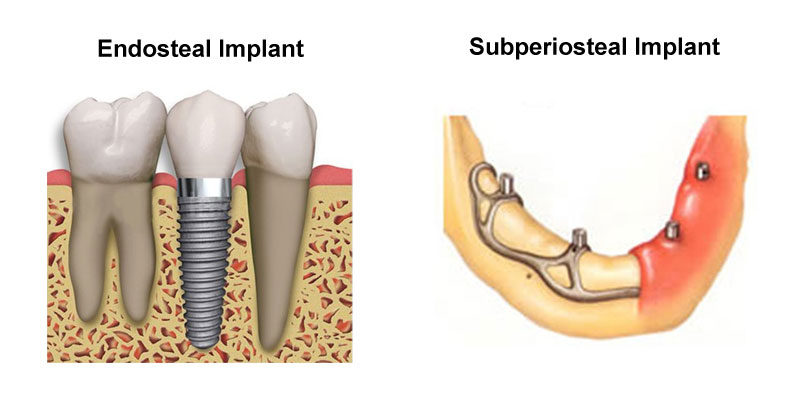 Subperiostal Implant in Turkey – Custom metal framework placed over jawbone for full arch restoration