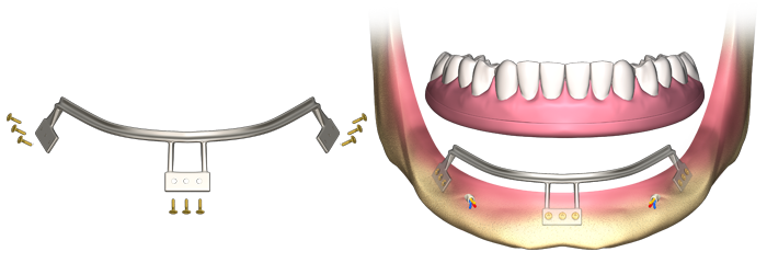 Before and after Subperiostal Implant in Turkey – restored facial structure and smile