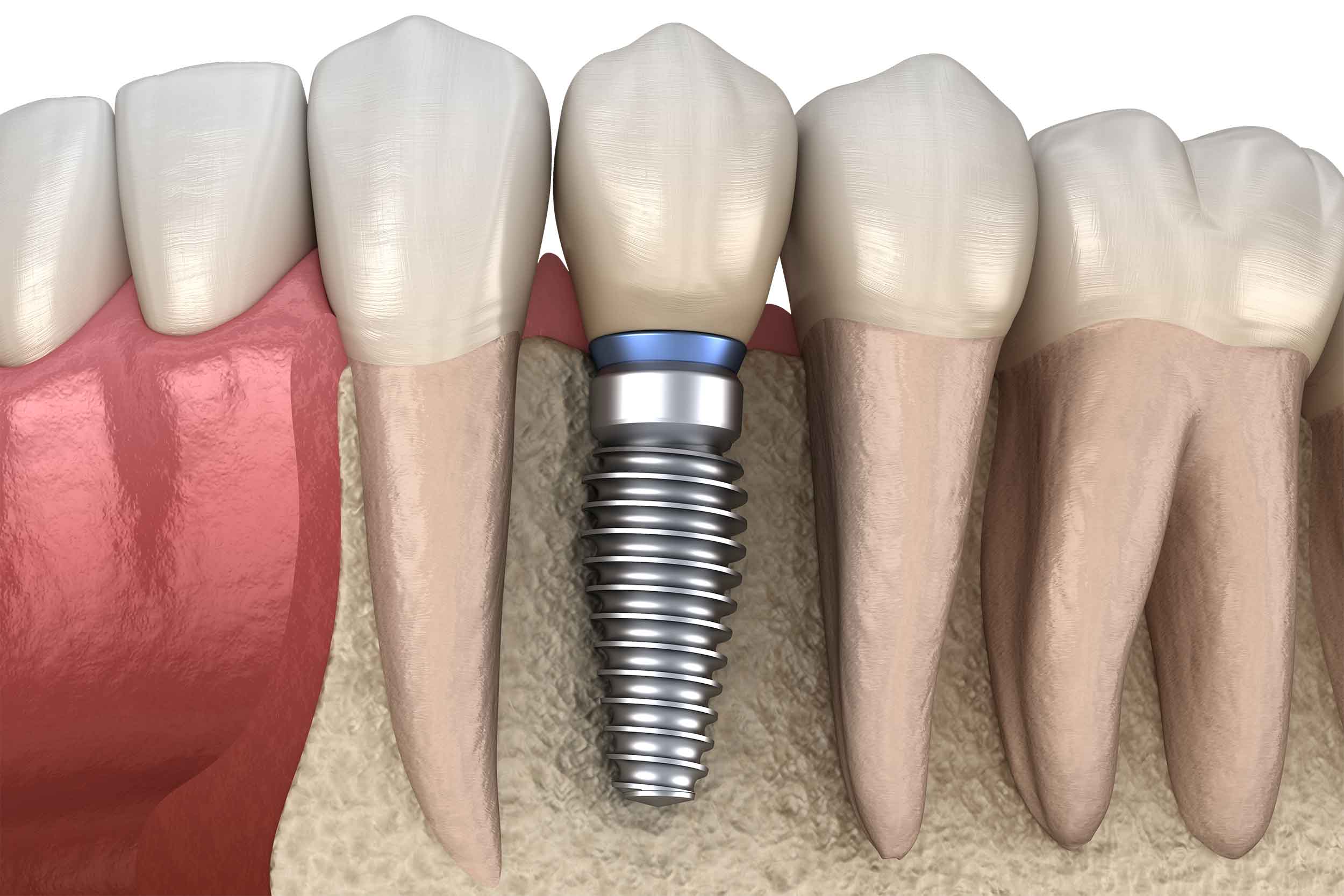 Subperiostal Implant in Turkey showing custom framework and final restoration