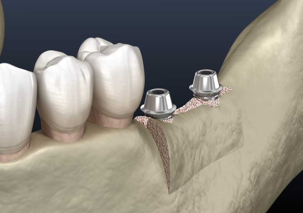 Subperiostal Implant in Turkey – Istanbul skyline during recovery and medical tourism