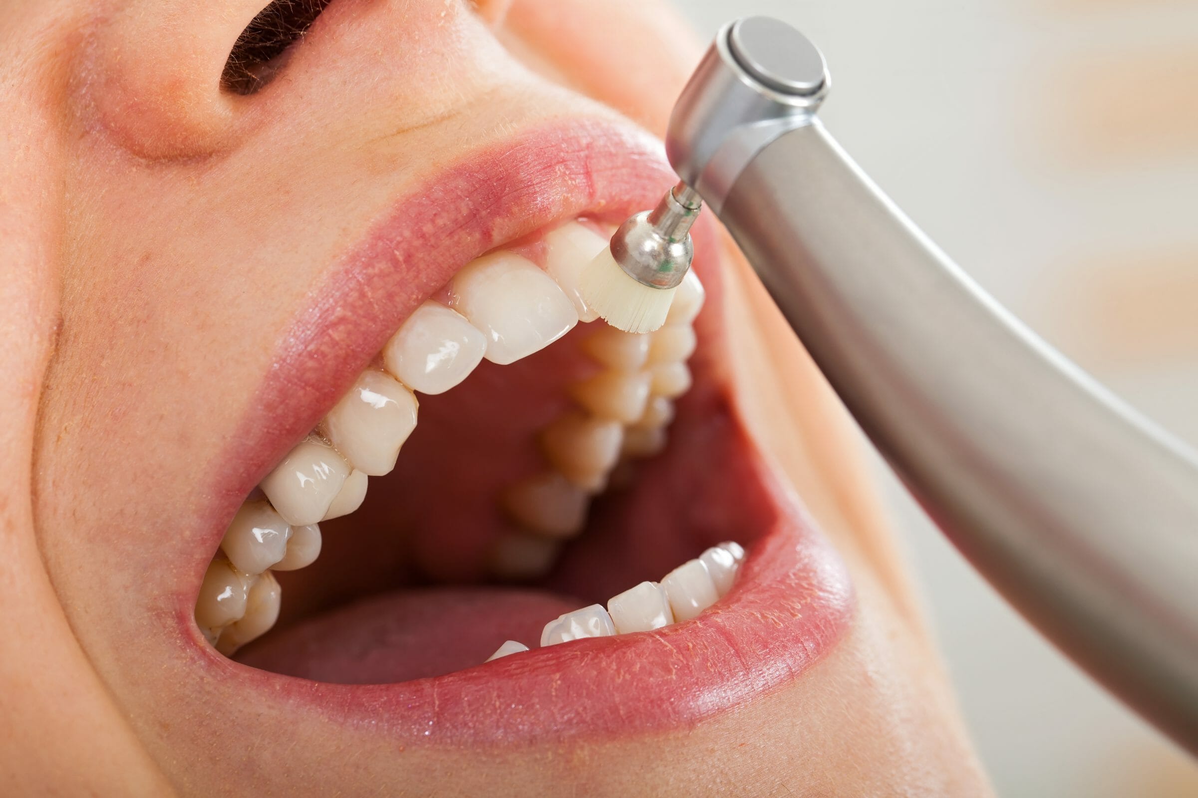 Before and after Teeth Cleaning in Turkey – natural aesthetic outcome