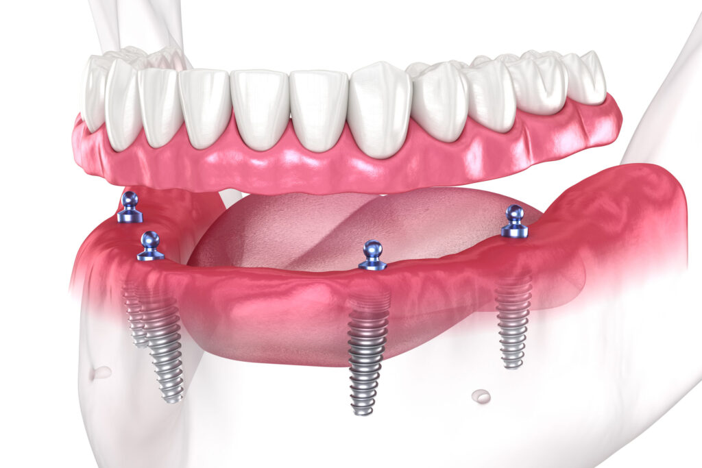 Dental Treatments Treatment Planning for International Patients