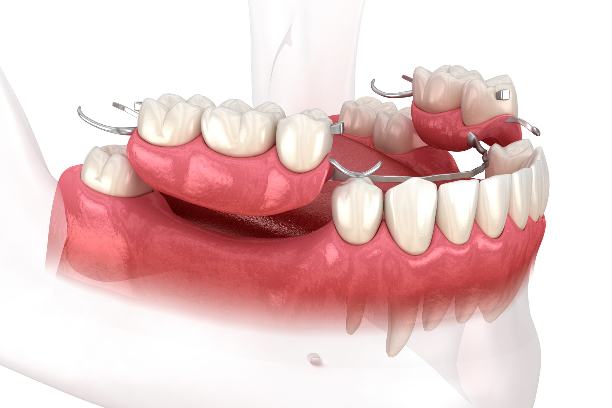 Before and after Temporary Dental Prosthesis in Turkey – natural aesthetic outcome