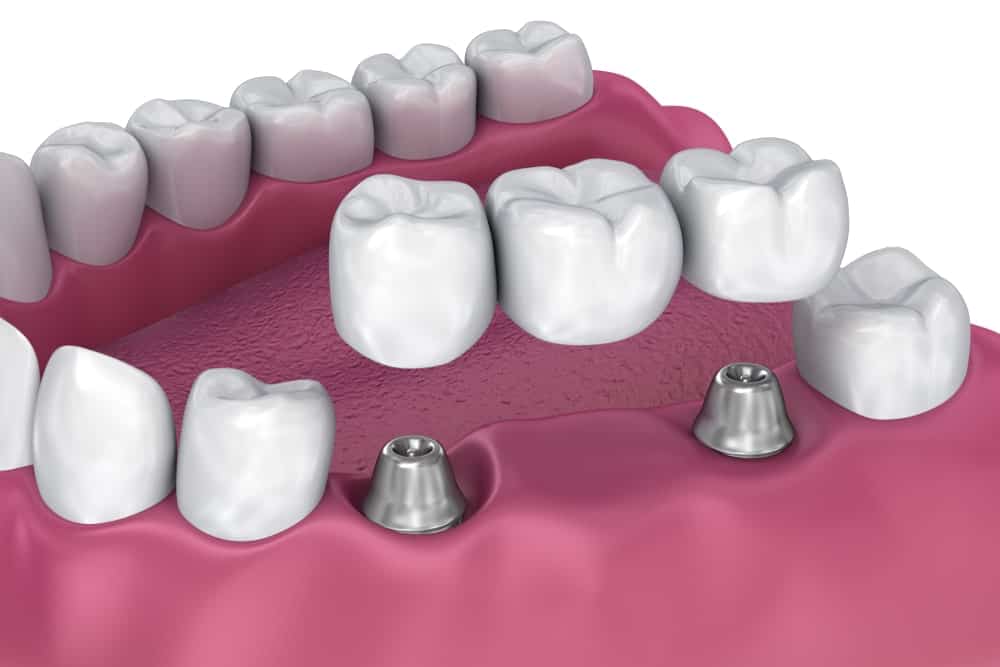 Temporary Dental Prosthesis in Turkey – Natural-looking and functional teeth during healing
