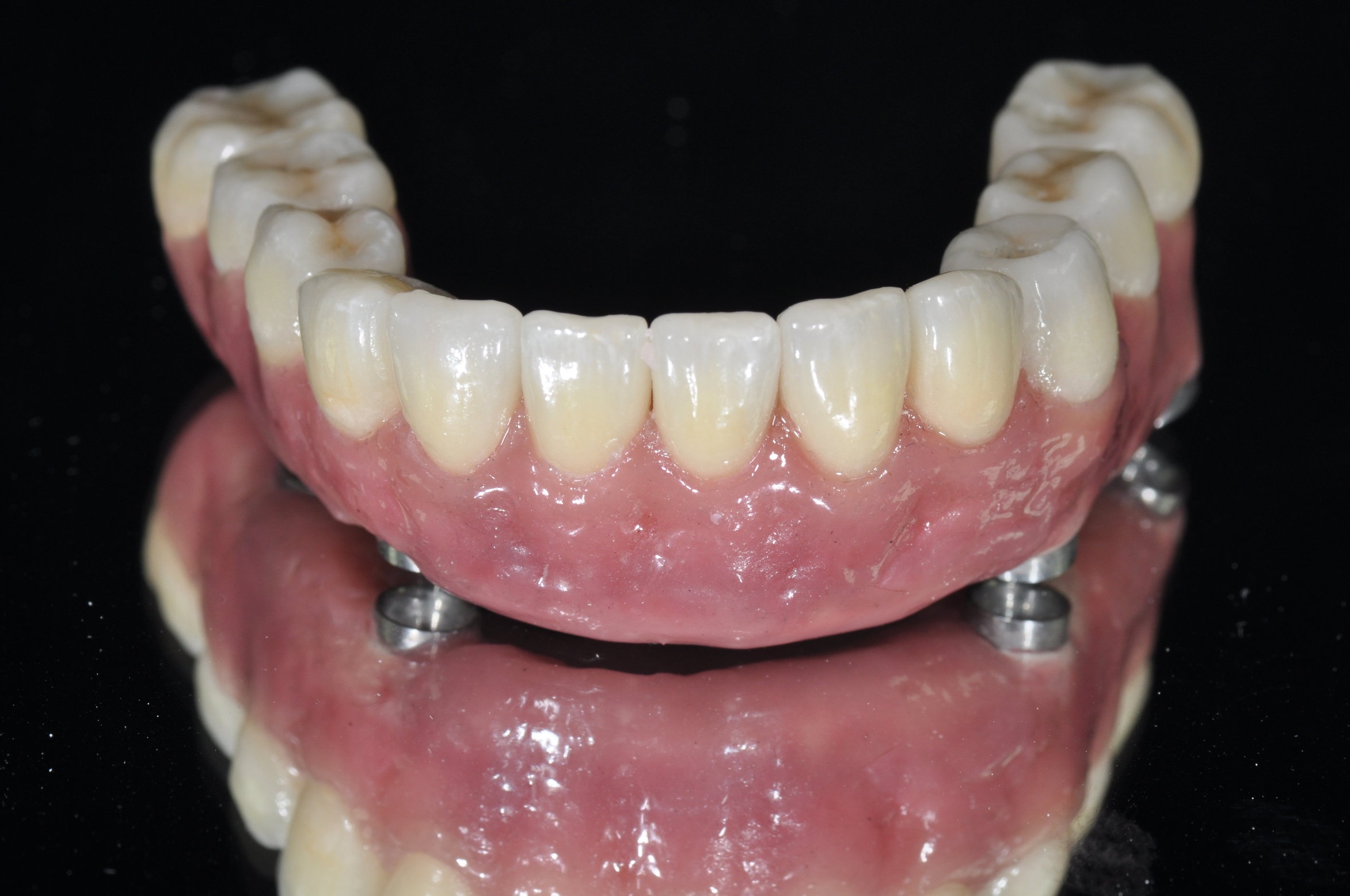 Temporary Dental Prosthesis in Turkey showing before and after results