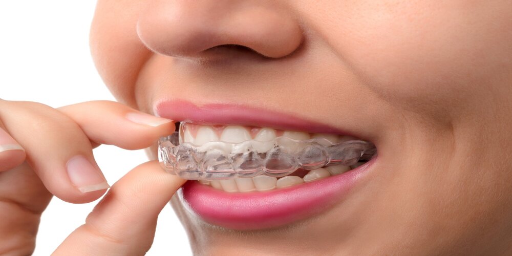 Transparent Plaque Treatment in Turkey showing before and after teeth alignment