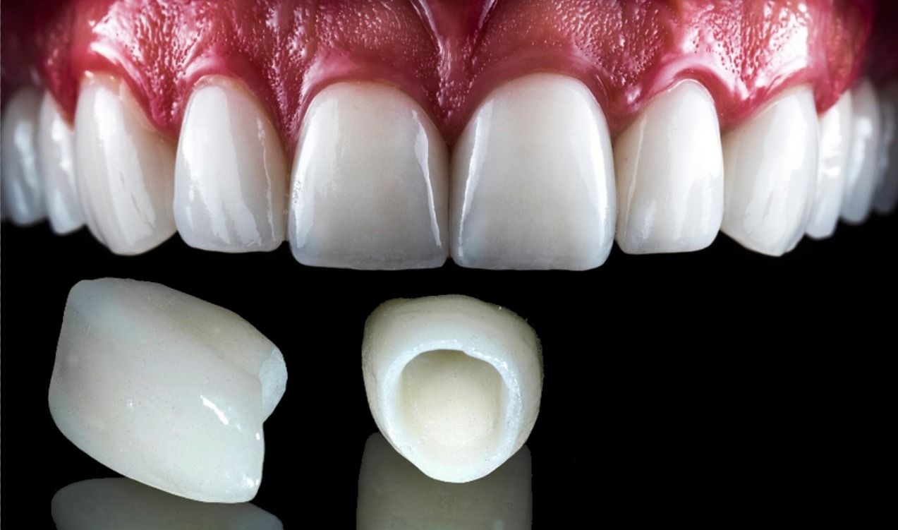 Before and after results of Zirconium Crowns in Turkey – natural aesthetic outcome