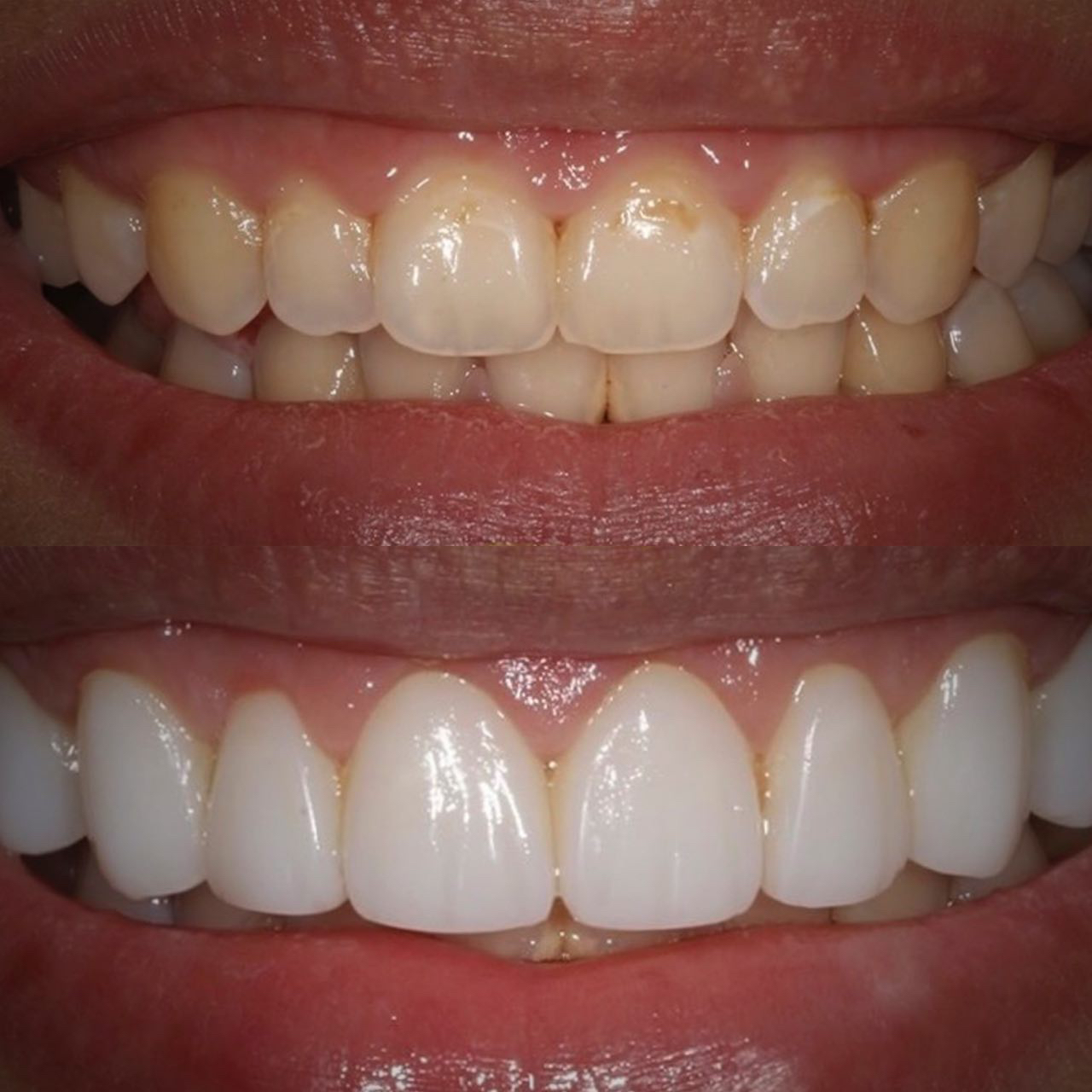 Zirconium Crowns in Istanbul – Premium dental crowns with natural appearance