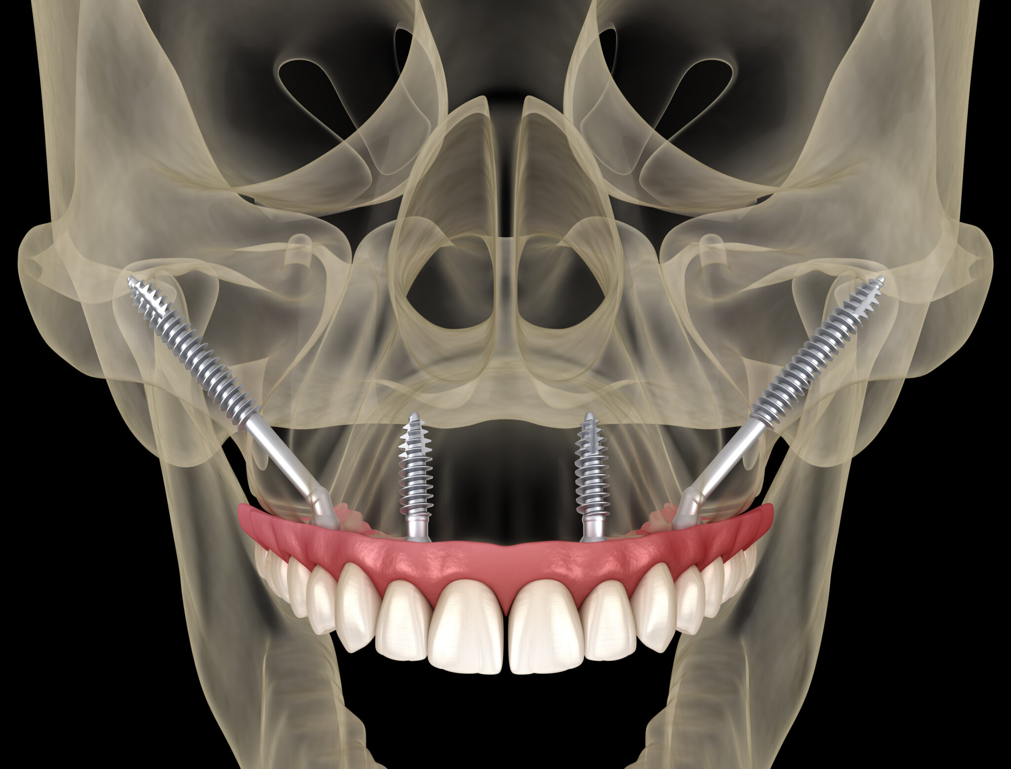 Zygomatic Implant in Turkey – Full mouth restoration without bone grafting