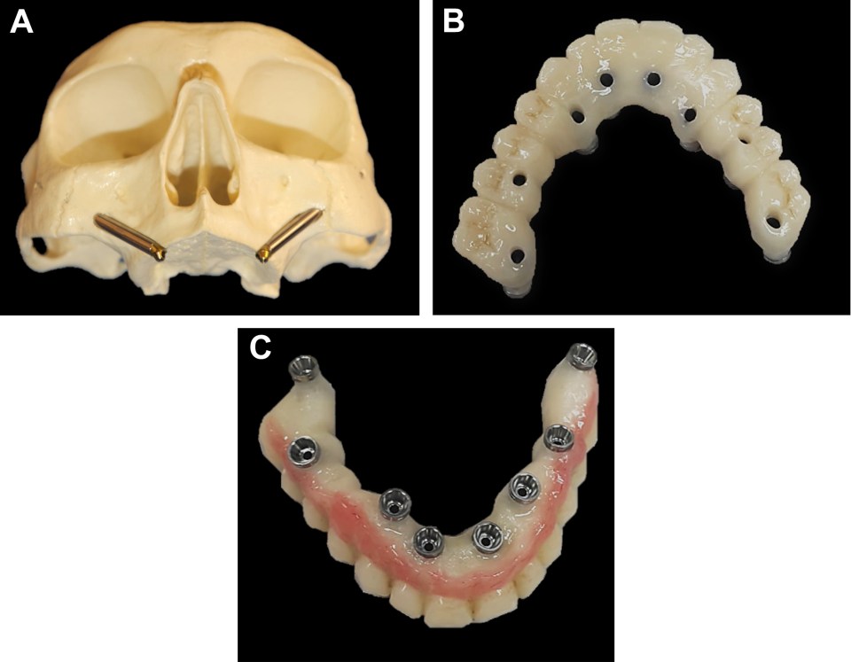 Zygomatic Implant in Turkey – Istanbul skyline during recovery and dental tourism