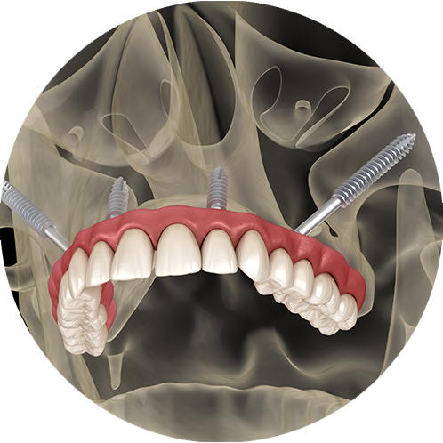 Zygomatic Implant in Turkey – 3D imaging and implant placement process
