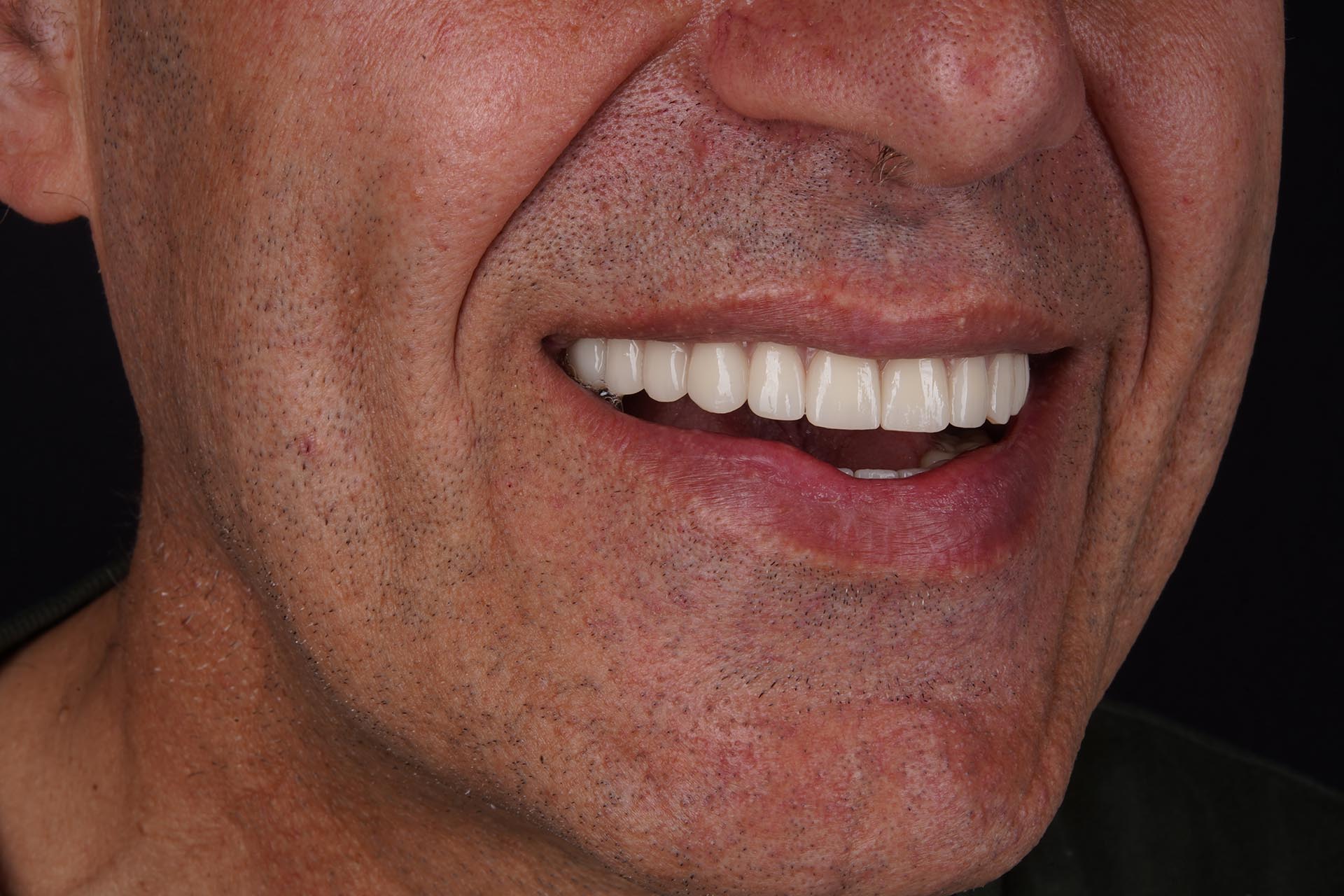 Before and after results of All on 4 in Turkey with natural aesthetic outcome