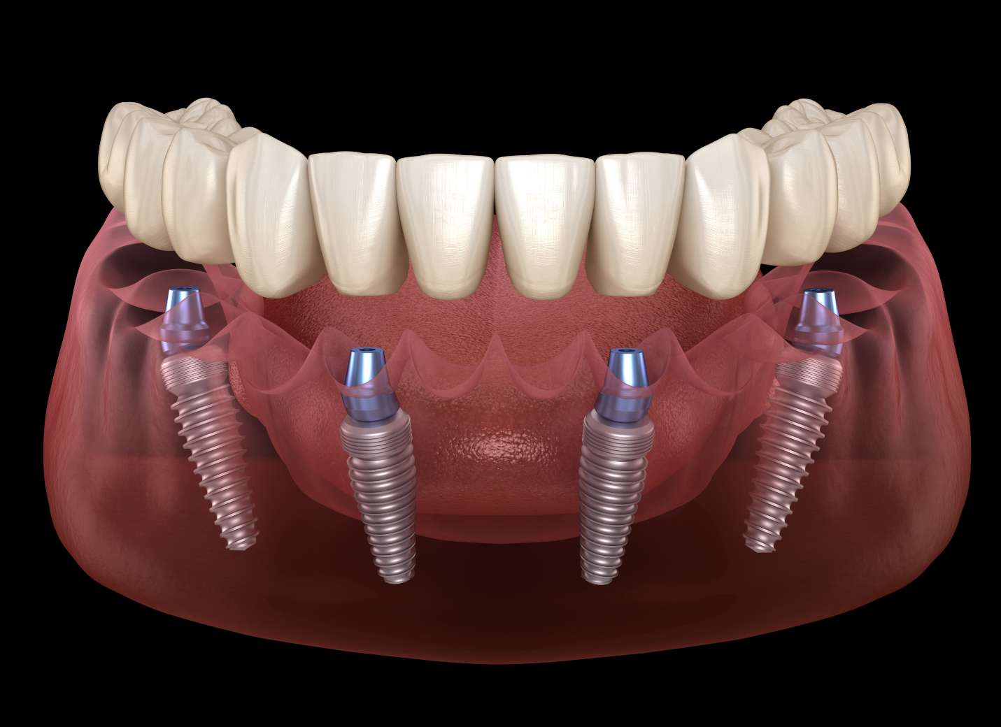All on 4 in Turkey – Full mouth dental implants with immediate loading and natural results