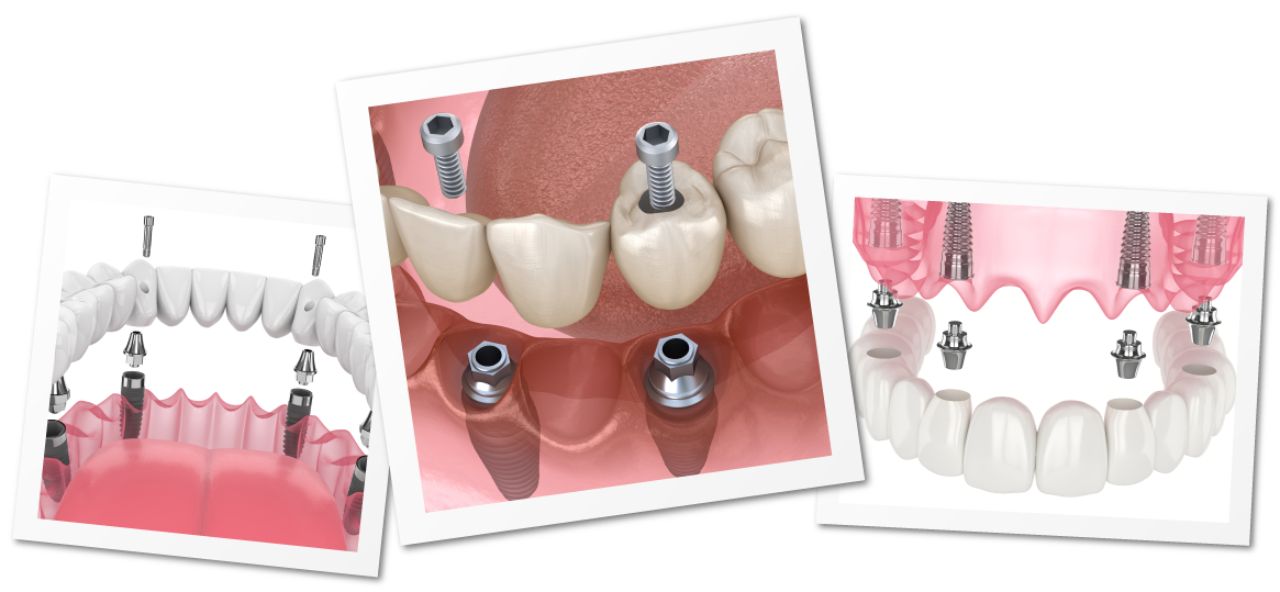 All on 4 treatment process in Turkey showing implant placement and immediate loading