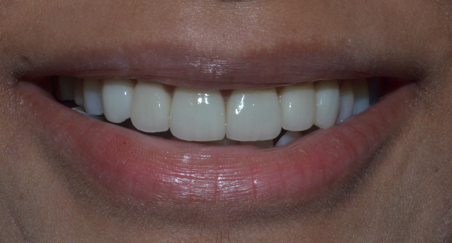 Dental Laminate Veneer in Turkey showing before and after results