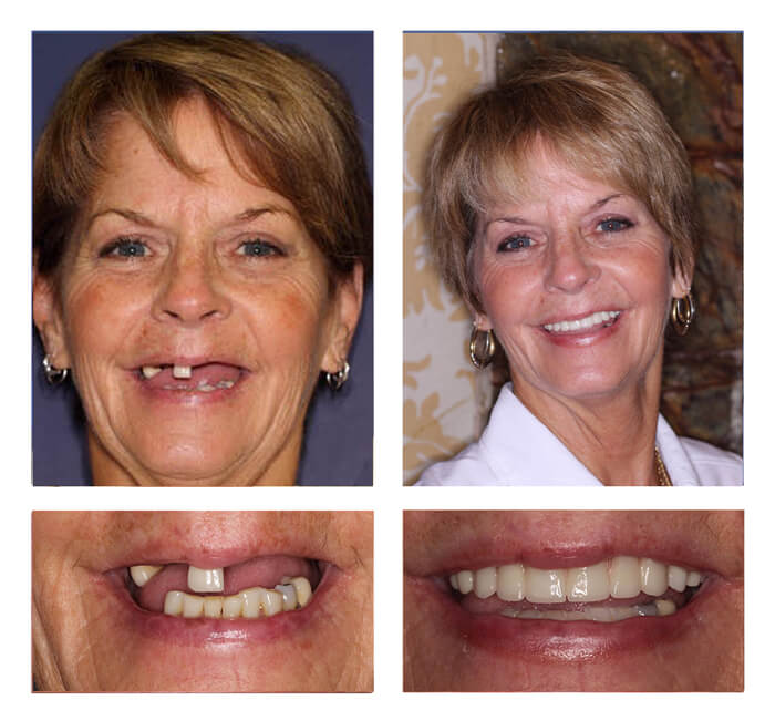Dental Treatments in Turkey