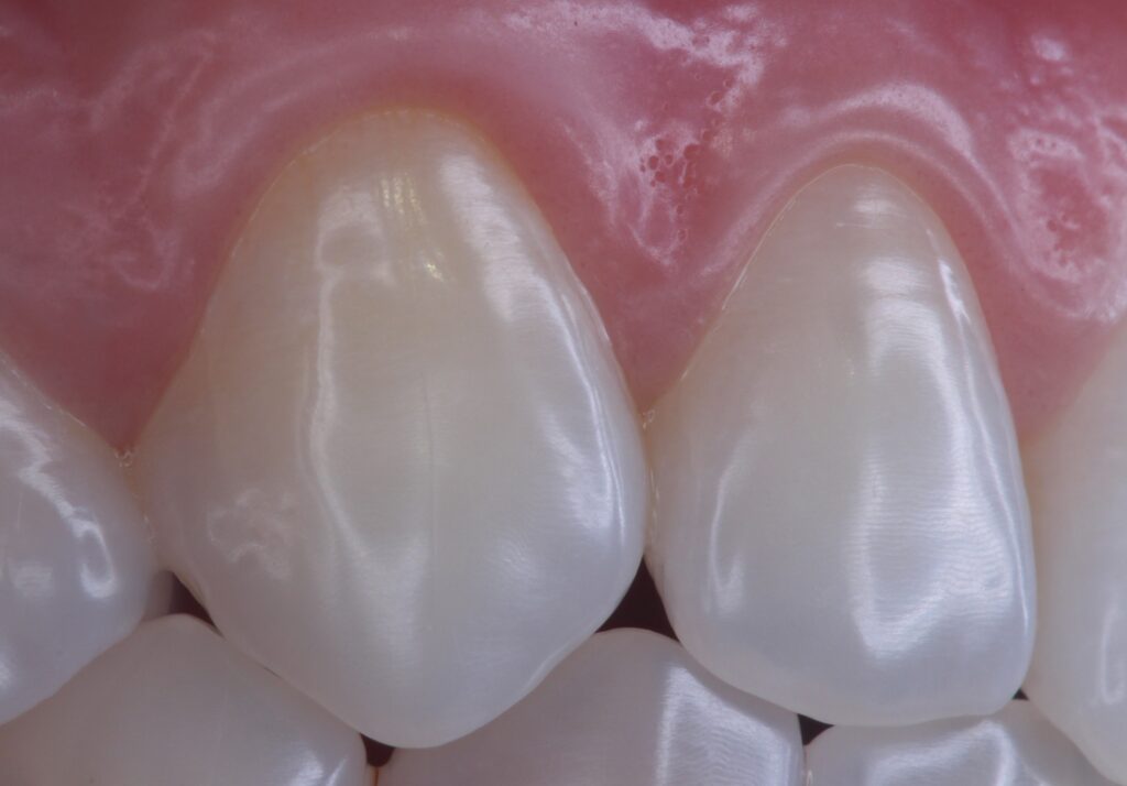 Emax Crowns in Turkey – Natural-looking ceramic crowns applied by expert dentists in Istanbul and Ankara