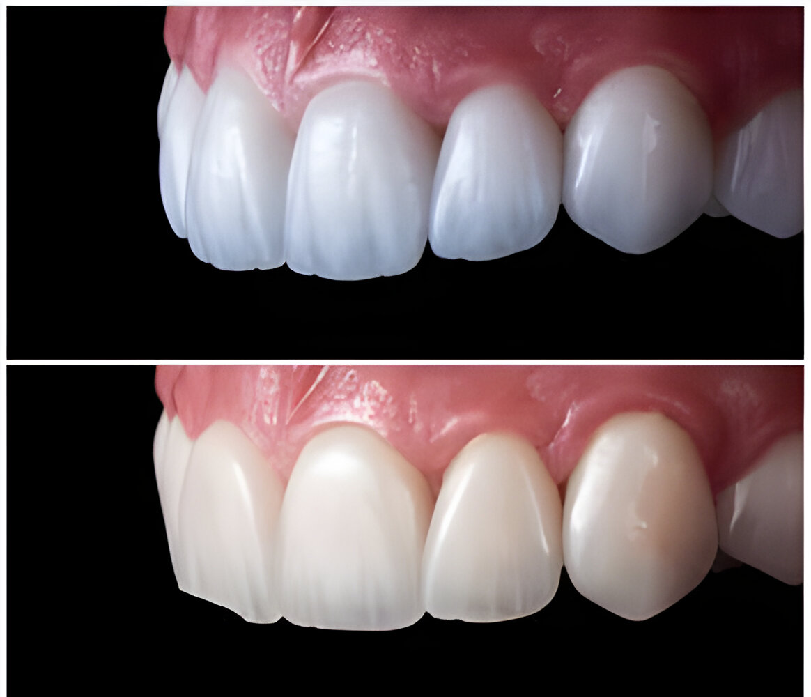 Before and after results of Emax crowns in Turkey with natural aesthetic outcome
