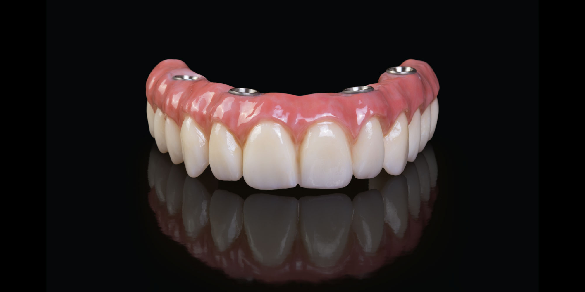Before and after Full Teeth Prosthesis in Turkey – natural aesthetic outcome