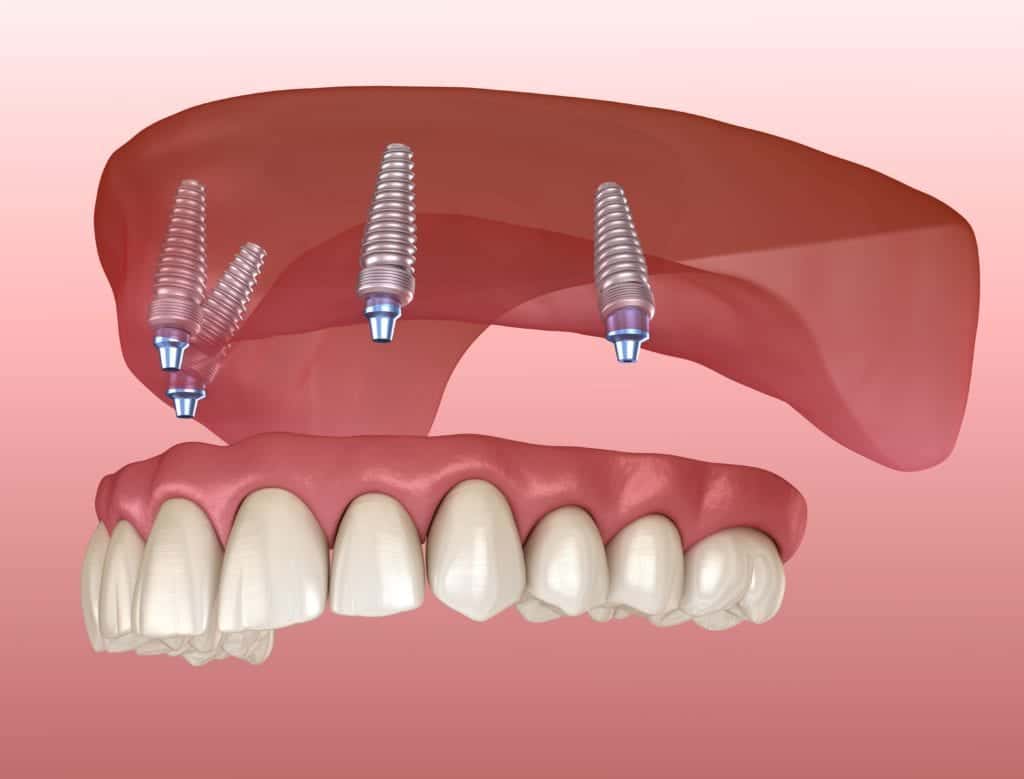 Full Teeth Prosthesis in Turkey – Natural-looking, durable dentures for missing teeth