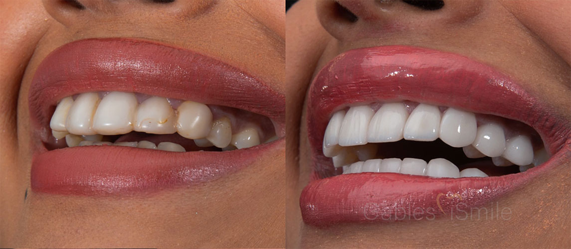 Hollywood Smile in Turkey – Bright, natural-looking smile transformation with veneers and smile design