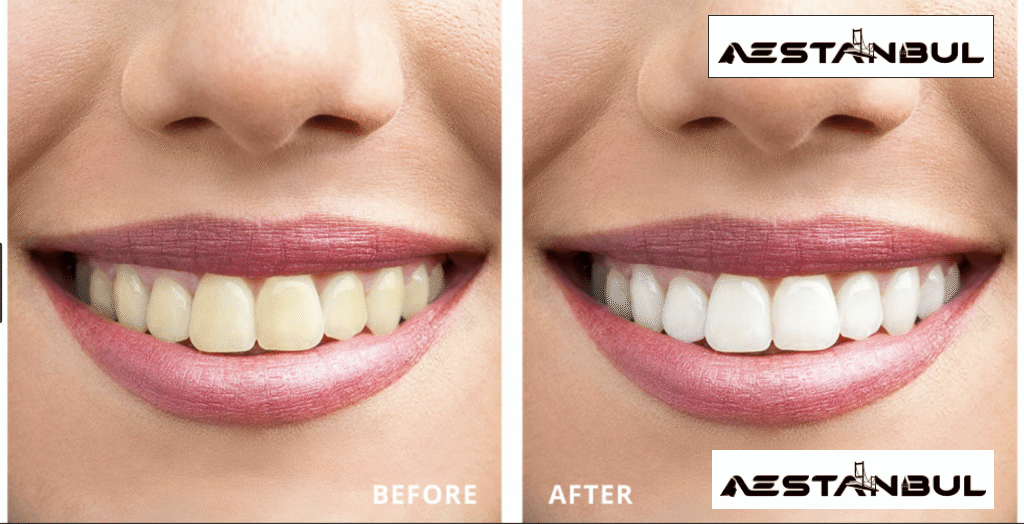 teeth whitening Turkey - Teeth Whitening Turkey: Patient Guide in Turkey