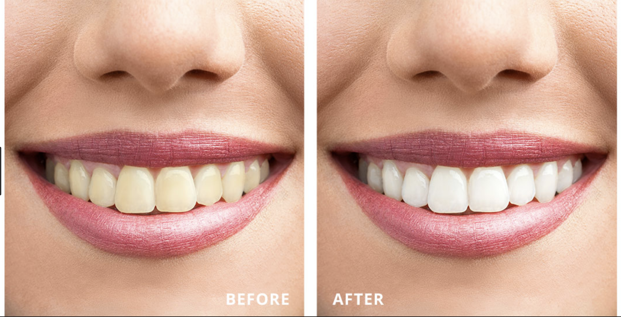 Ross family Teeth Whitening in Turkey – Natural and family-friendly results