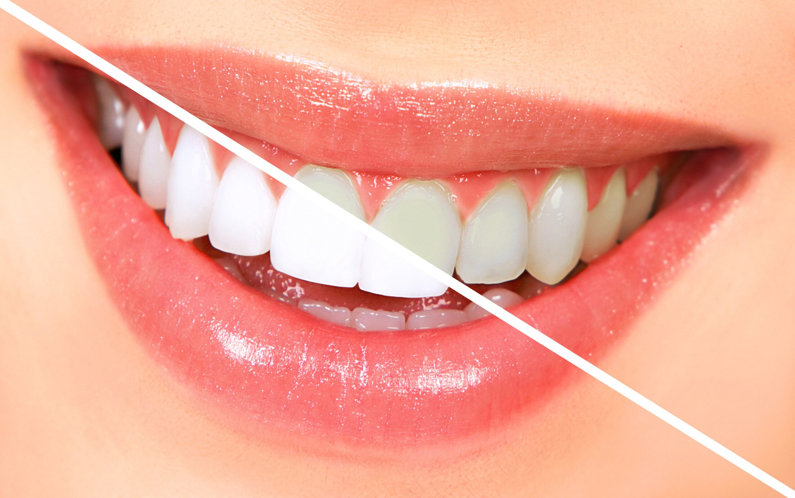 Professional Teeth Whitening in Turkey showing before and after results