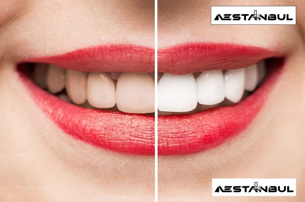 Teeth Whitening Turkey: Patient Guide in Turkey teeth whitening Turkey - Teeth Whitening