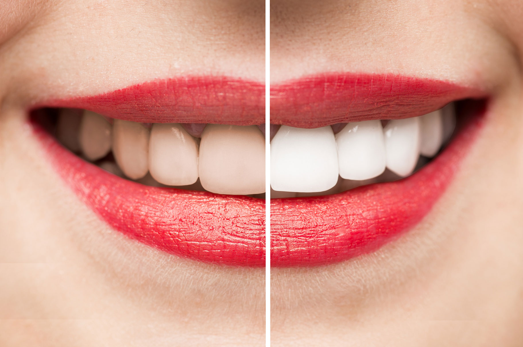 Before and after Teeth Whitening in Turkey – natural aesthetic outcome