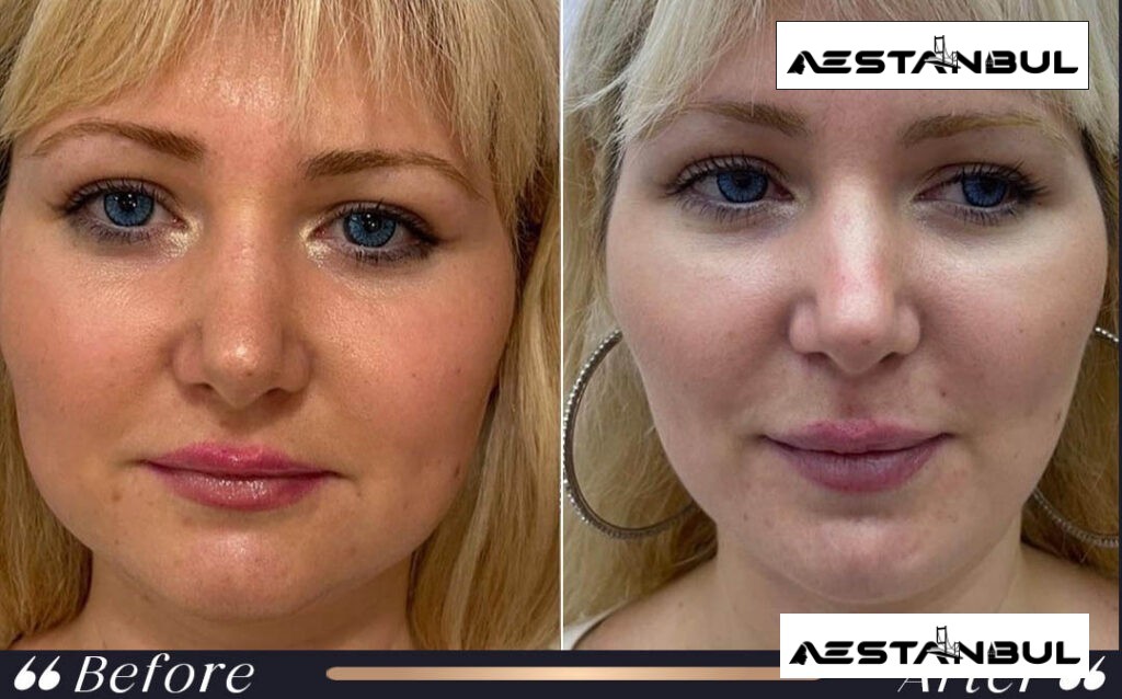 facial feminization surgery Turkey - Facial Feminization Surgery