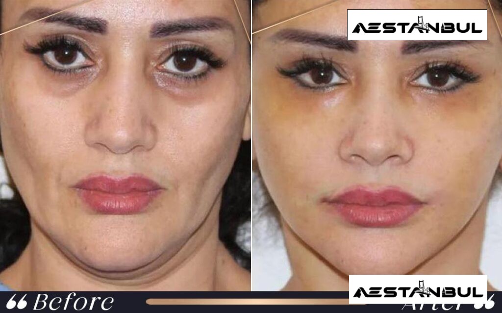 facial feminization surgery Turkey - Facial Feminization Surgery Turkey: What International Patients Should Know