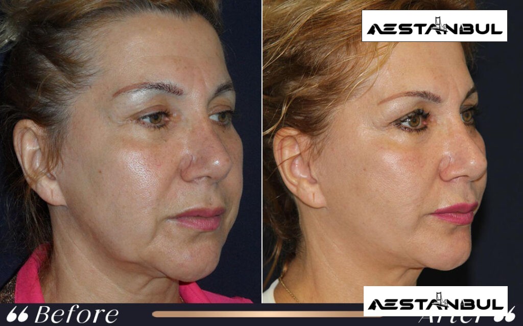 facial feminization surgery Turkey - Facial Feminization Surgery Turkey: What International Patients Should Know
