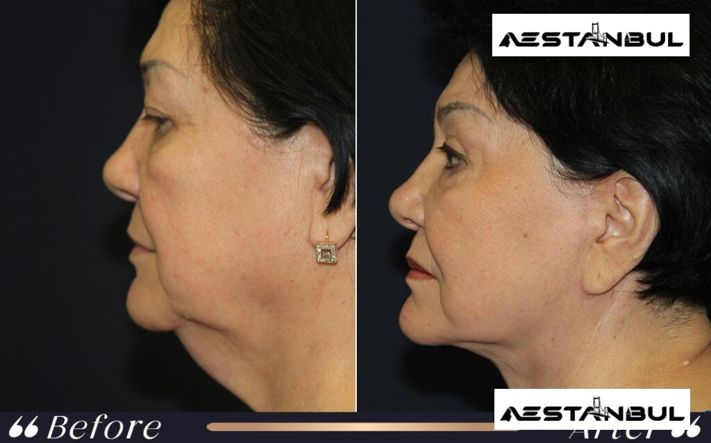 facial feminization surgery Turkey - Facial Feminization Surgery Turkey: What International Patients Should Know