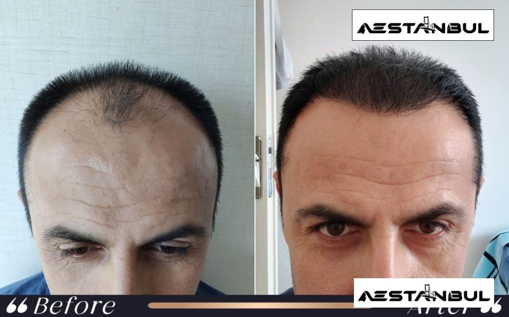 turkey hair transplant cost - Hair Transplant