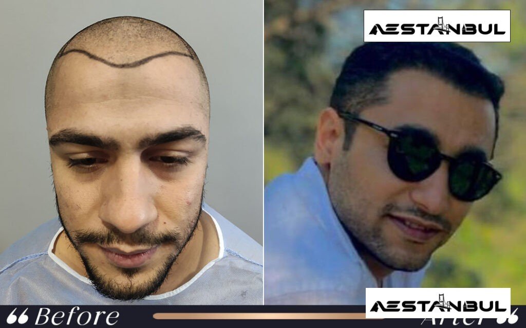 Hair Transplant Price Safety - Hair Transplant Price Safety: Price Versus Safety Comparison for 2026
