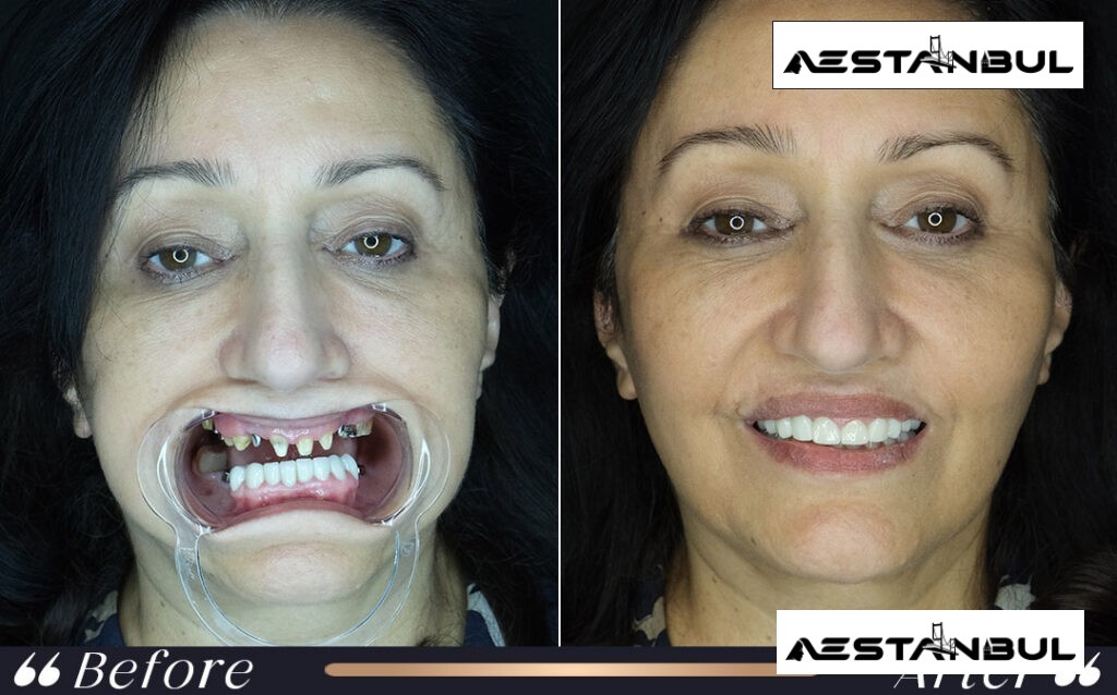 SMILE eye surgery Istanbul - Smile Eye Surgery Istanbul: What International Patients Should Know