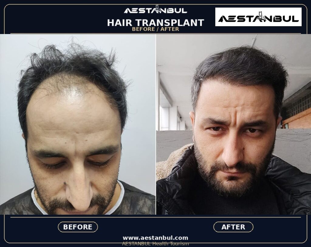 laser hair removal Istanbul - Laser Hair Removal Istanbul: What International Patients Should Know