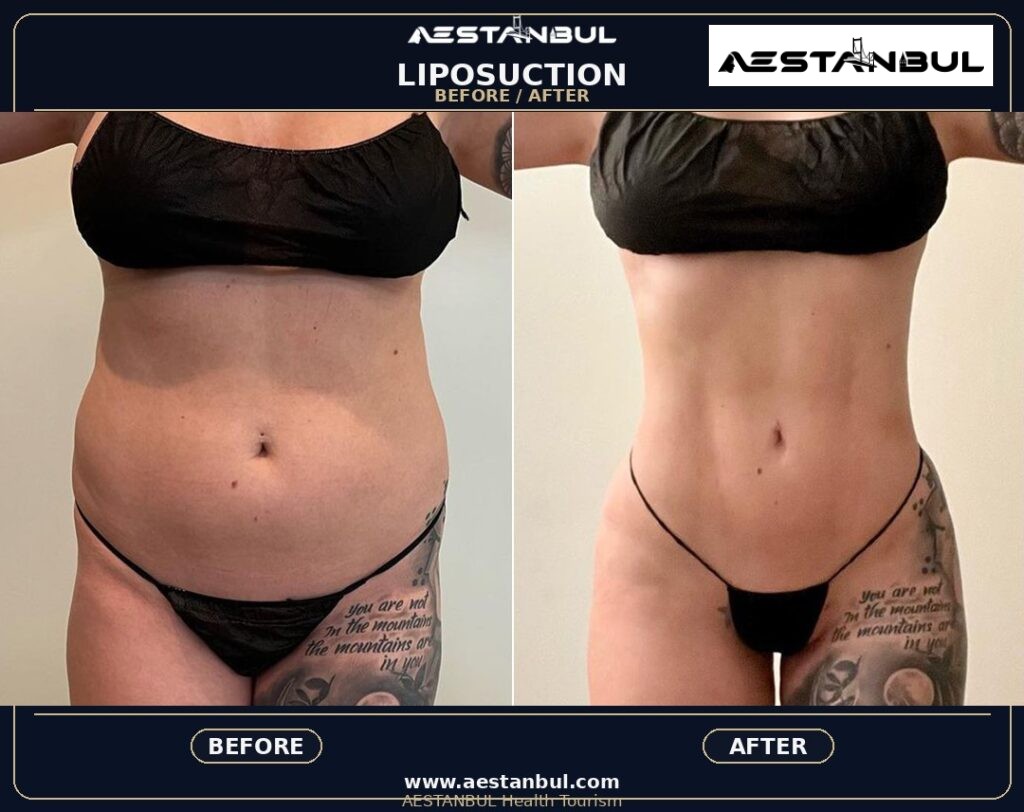 liposuction before and after Turkey - Liposuction Before And After Turkey: Results, Safety and Patient Questions