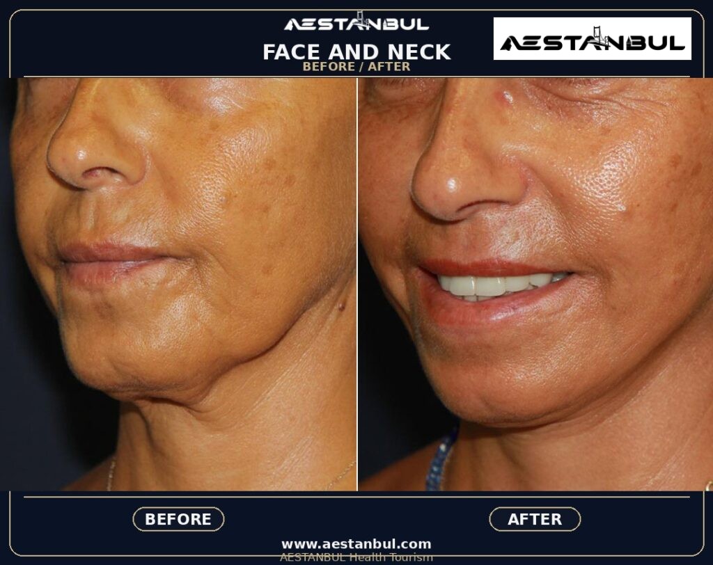Facelift Aftercare Timeline: Aftercare Timeline Questions for 2026 1 292d4d7f