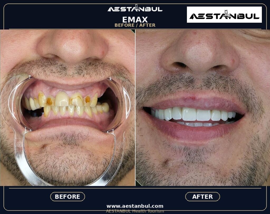 Dental Veneers Before And After Turkey: Results, Safety and Patient Questions 1 334f3c80