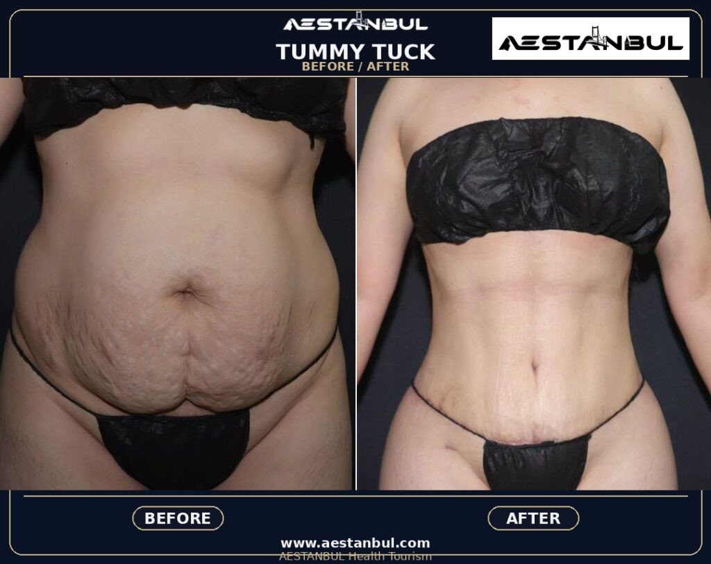 Tummy Tuck Aftercare Timeline - Tummy Tuck Aftercare Timeline: Aftercare Timeline Questions for 2026