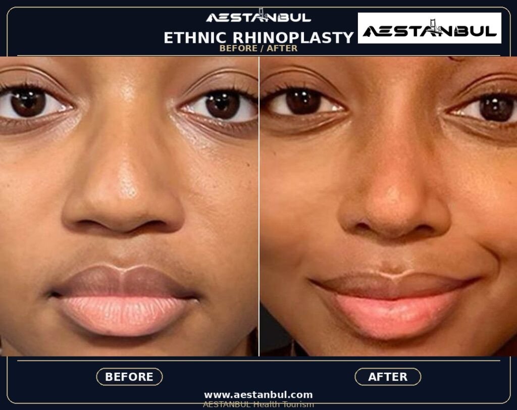 Rhinoplasty UK Checklist - Rhinoplasty Uk Checklist: UK Patient Checklist for 2026