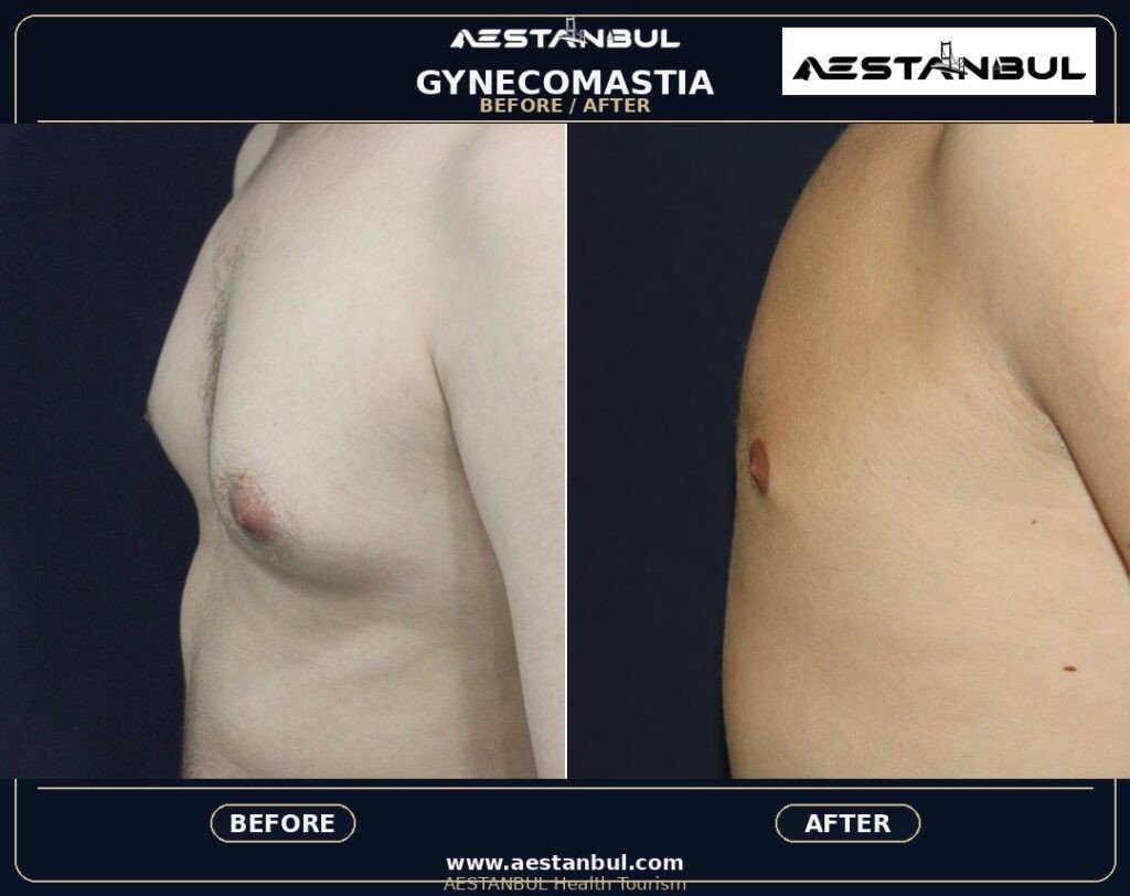 gynecomastia Turkey - Gynecomastia Turkey: Patient Guide in Turkey