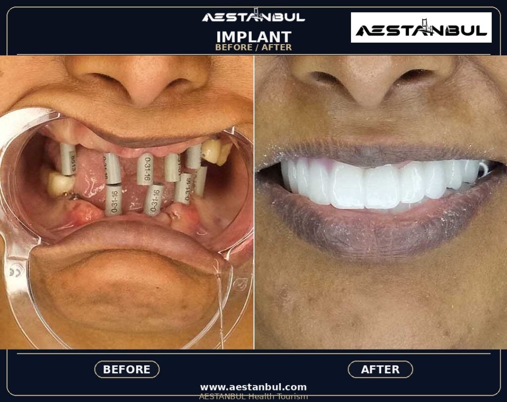 Dental Implants Photo Consultation - Dental Implants Photo Consultation: Photo Consultation Checklist for 2026