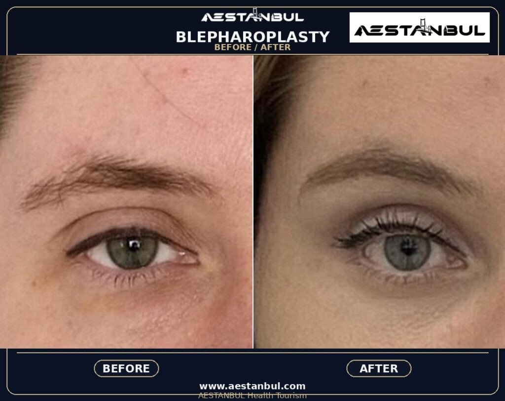 Blepharoplasty Revision Questions - Blepharoplasty Revision Questions: Revision Risk Questions for 2026