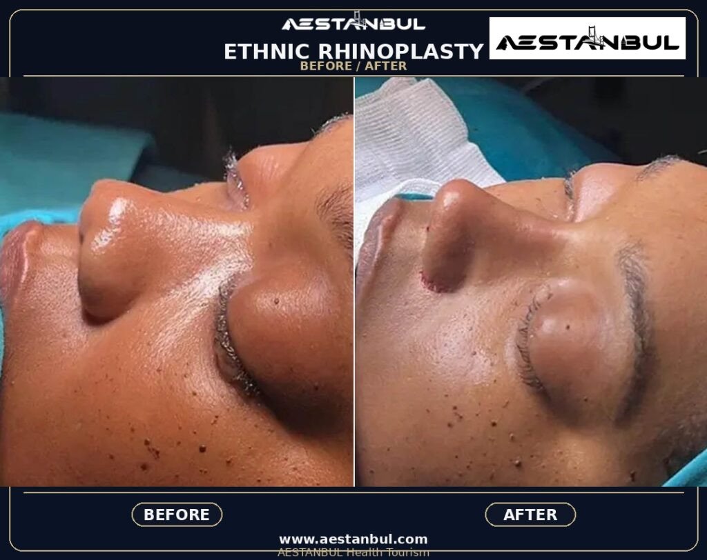 Revision Rhinoplasty Revision Questions - Revision Rhinoplasty Revision Questions: Revision Risk Questions for 2026