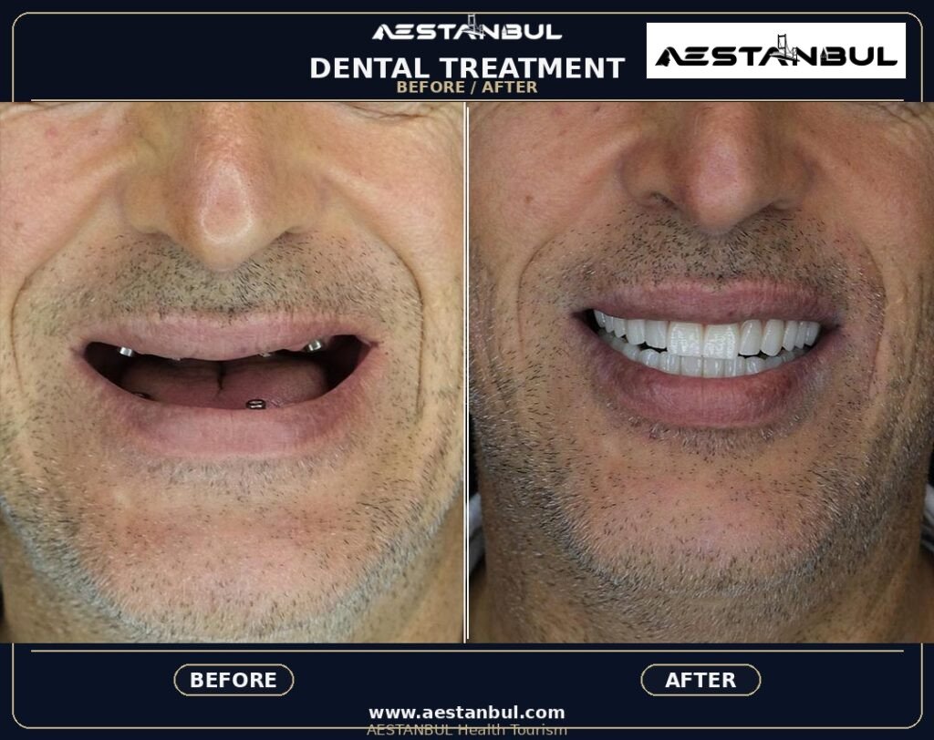 Hollywood Smile Aftercare Timeline - Hollywood Smile Aftercare Timeline: Aftercare Timeline Questions for 2026
