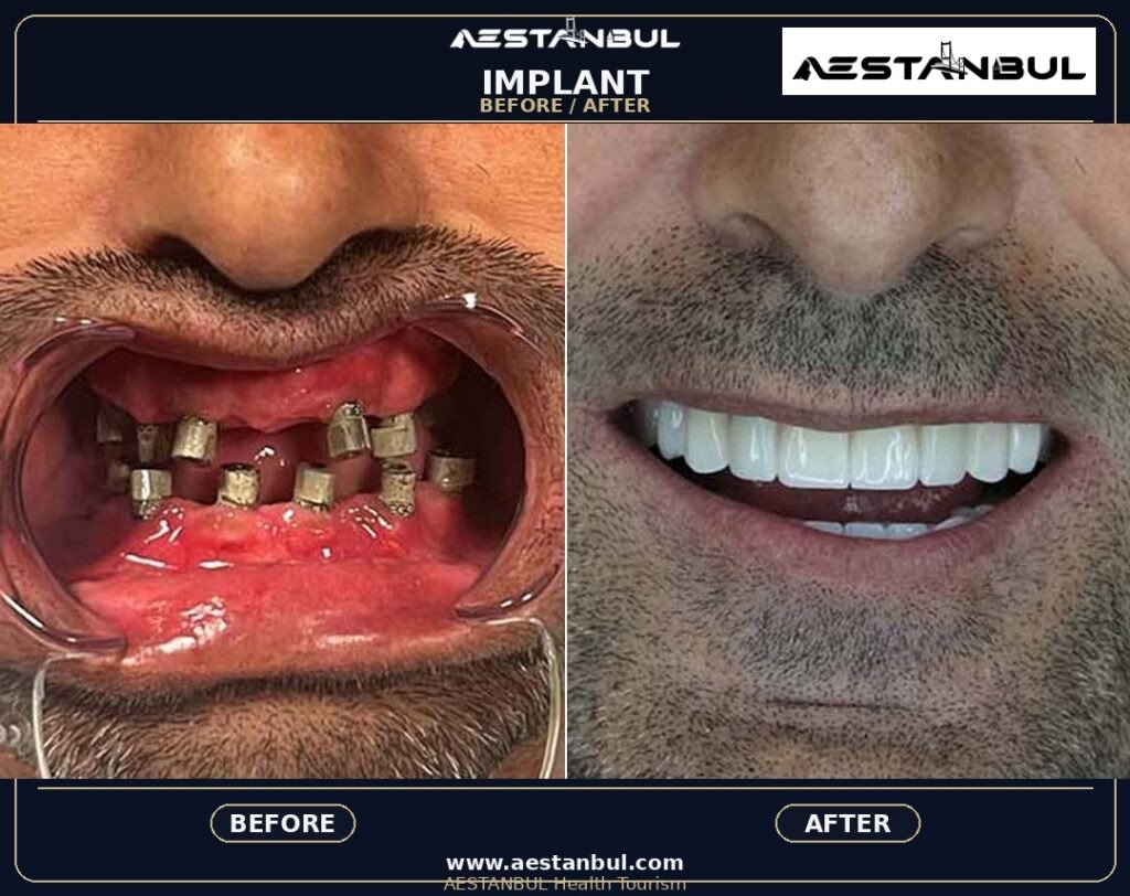 All-on-4 Dental Implants Deposit Questions - All-on-4 Dental Implants Deposit Questions: Deposit Questions Before Booking for 2026